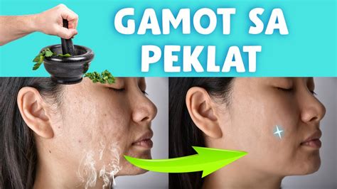 gamot sa peklat ng bata|MABISANG PANTANGGAL NG PEKLAT NI BABY .